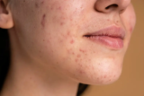 What causes hormonal acne | Credihealth